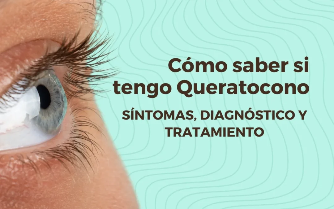 Cómo Saber si Tengo Queratocono: síntomas, diagnóstico y tratamiento